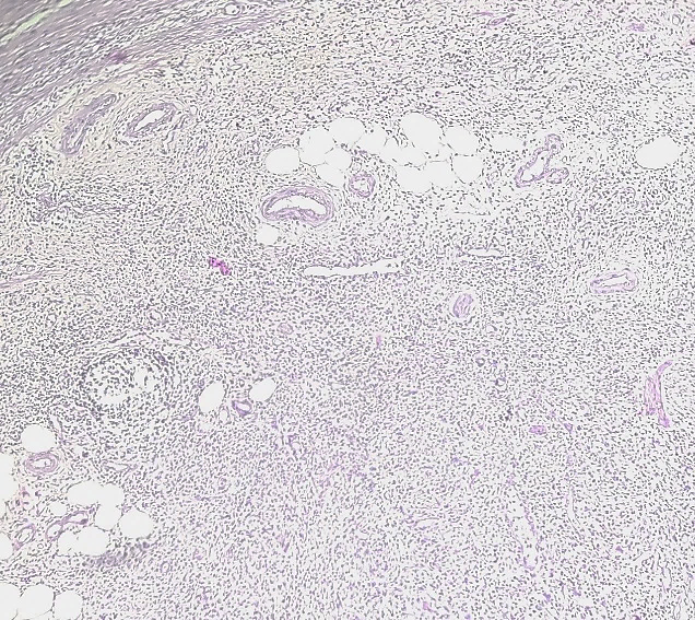 H & E (10x) stained section shows nerve bundles surrounded by fibroadipose tissue in case of fibrolipomatous hamartoma of nerve