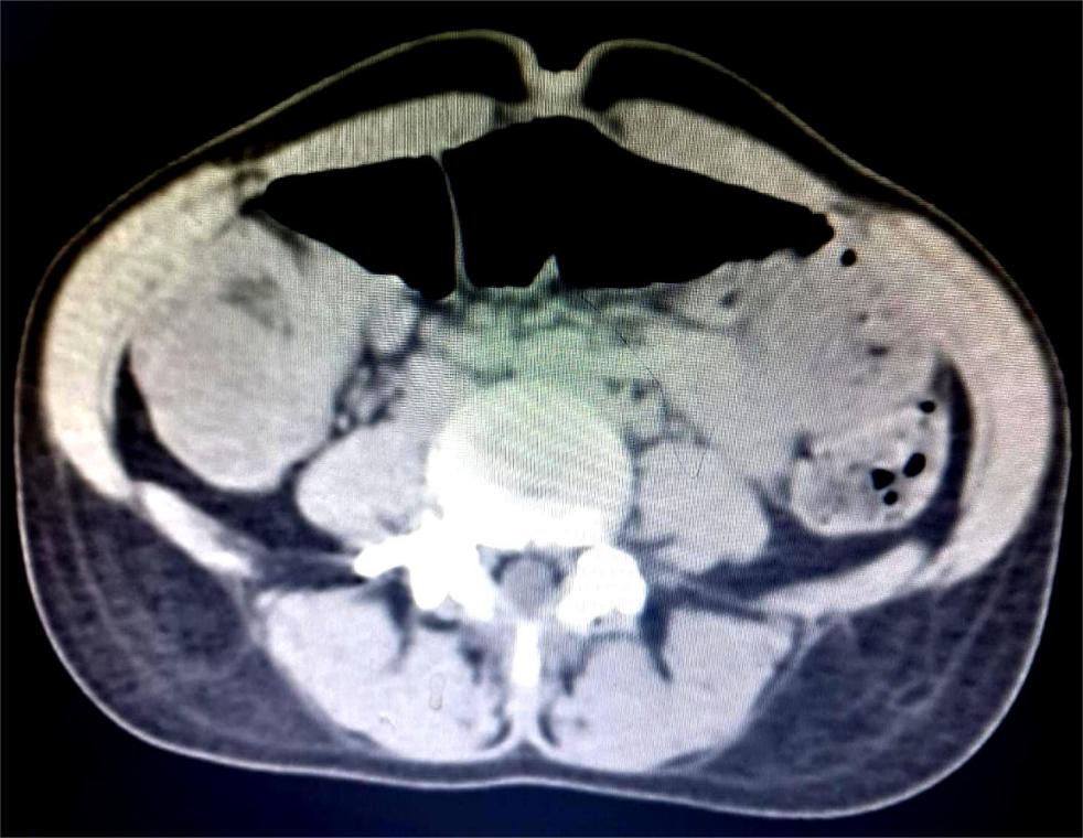 Contrast-enhanced computed tomography scan of the abdomen, showing a small intestinal loop telescoping into to small bowel loop (blue arrow)