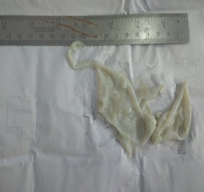 Gross: pearly white cyst membrane