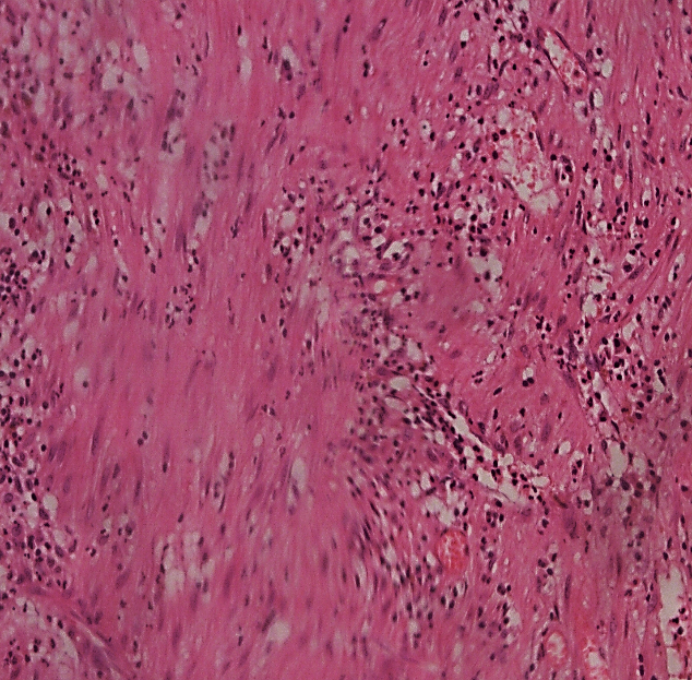 Pericyst layer: 40 X granulation tissue forming the pericyst layer