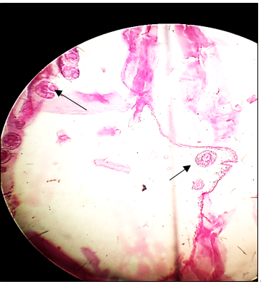 Endocyst: 40 X showing endocyst with scolices (shown by arrow)