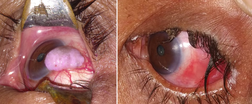Nodular shape large gelatinous OSSN (squamous cell carcinoma) at temporal linbus with positive rose Bengal stain and feeder blood vessels, completely resolved after surgical excision and post operative MMC treatment.