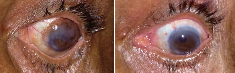 These figure showing dual finding of squamous cell carcinoma and malignant melanoma which was treated with surgical excision + MMC.