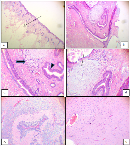 a): H&E stained photomicrograph at x40 showing epidermis, thin dermis and subcutis. Arrow showing the mature adipocytes close to epithelium; (b): H&E stained photomicrograph at x40 showing the reticular dermis having a mature teratoma composed of chondroid matrix, respiratory epithelia and seromucinous glands; (c): H&E stained photomicrograph at x100 with arrowhead and arrow showing respiratory epithelia and seromucinous glands respectively; (d): H&E stained photomicrograph at x100 with arrow showing the chondroid matrix; (e)&(f): H&E stained photomicrographs at x100 showing different fields of neural tissue in myelomeningocele.