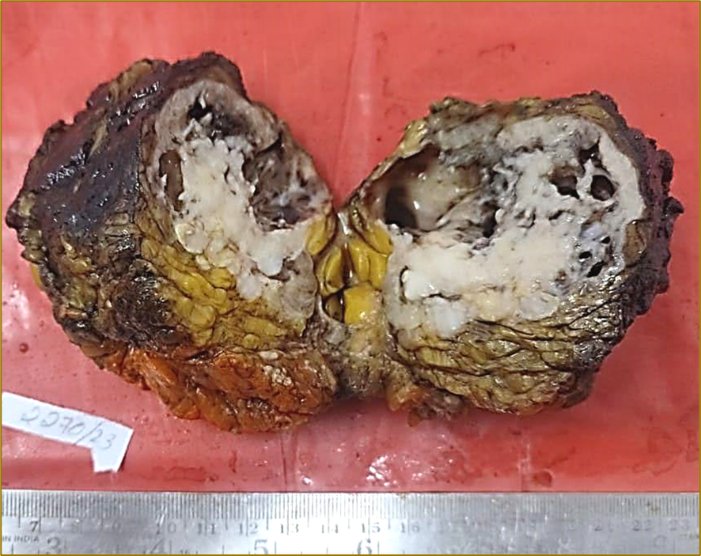 Wide local excision specimen showing ill-circumscribed grey-white firm lesion with cystic spaces