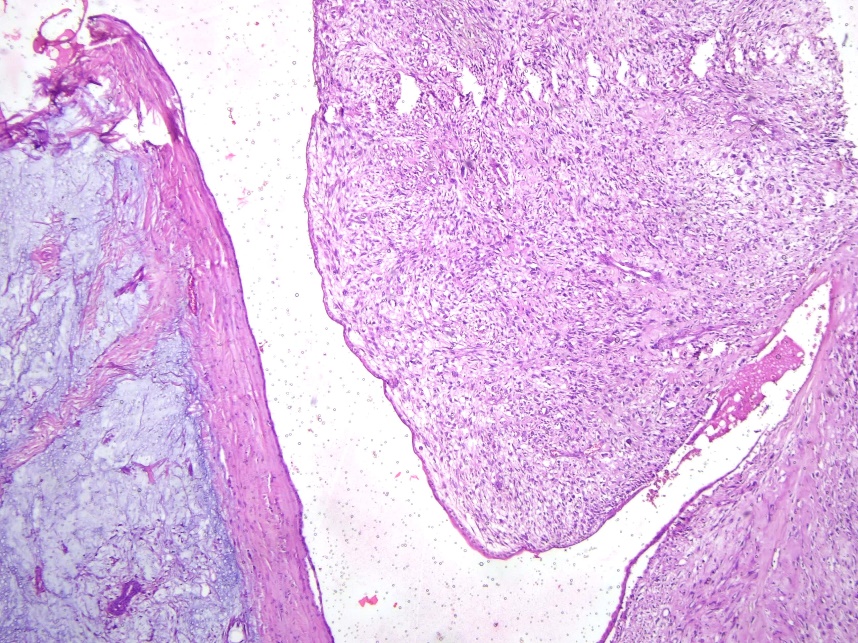 Leaf-like fronds with underlying stromal proliferation (on right) andmyxoid areas (on left). H&E 40x