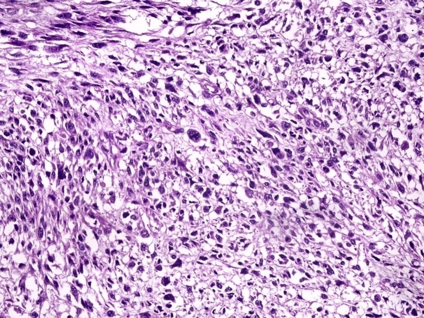 Markedly pleomorphic stromal cells with increased mitoses. H&E. 200x