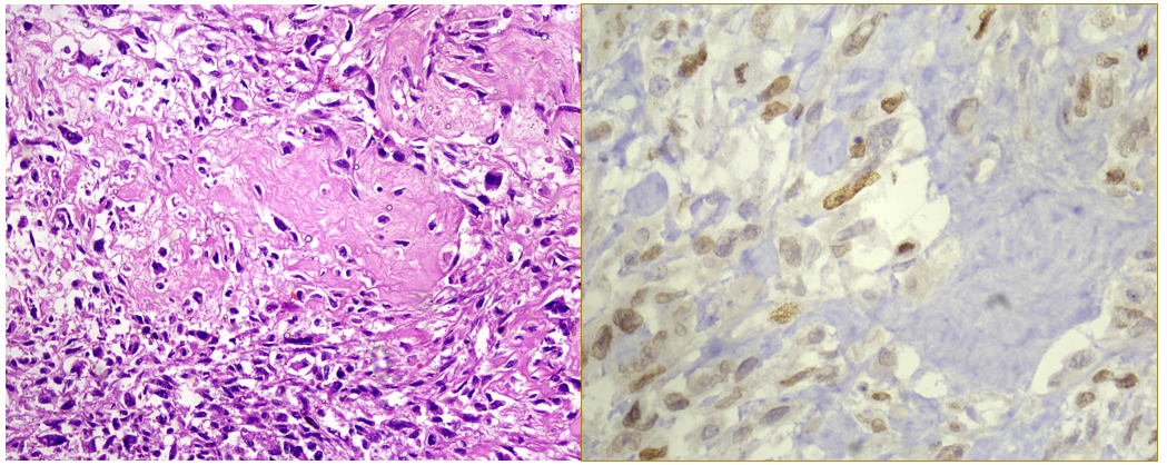 Tumour osteoid with malignant stromal cells (left; H&E. 400x) showing SATB2 positivity (right; 400x)