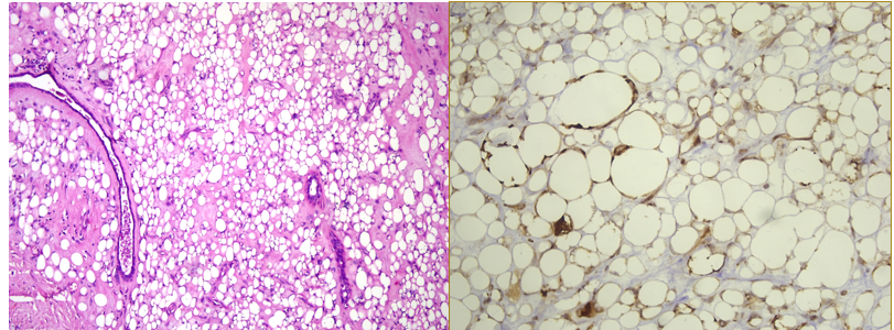 Area of well-differentiated liposarcoma (left; H&E. 100x) showing MDM2 positivity (right; 200x)