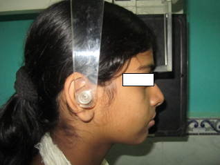 Ear rods and the nasal positioner secured for recording of cephalogram.