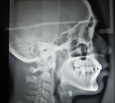 A Lateral Cephalogram.