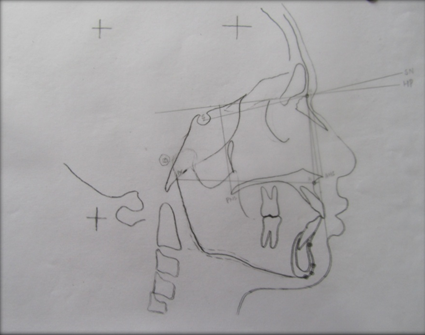 Tracings of skeletal maxilla parameters.