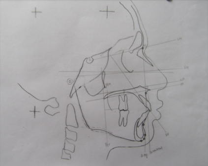 Tracings of dentoalveolar maxilla parameters.