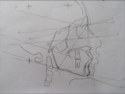 Tracings of skeletal mandible parameters.