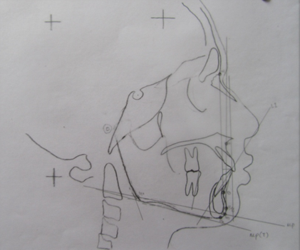 Tracings of dentoalveolar mandible parameters.