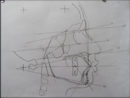 Tracings of maxillo mandibular parameters.