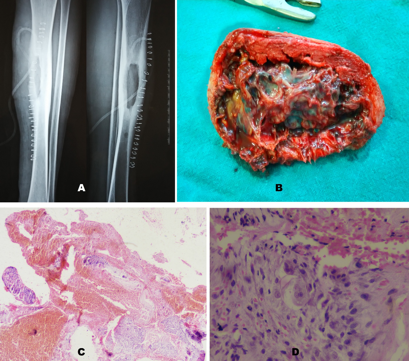 Post-traumatic Large Aneurysmal Bone Cyst of Tibial Diaphysis in an Adolescent: Report of a Rare Case