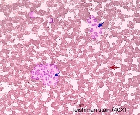 Blood peripheral smear using leishman stain shows neutrophils in clusters suggestive of leuko-agglutination (Blue arrows) on a background of red blood cells.