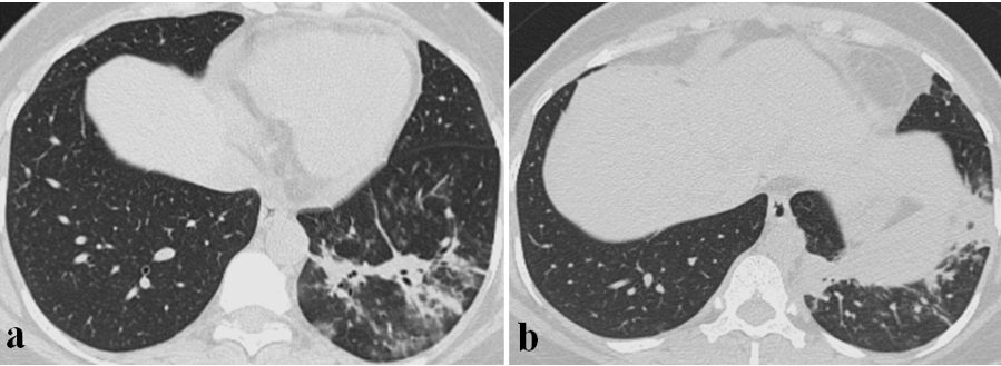 High Resolution CT chestAxial images show (a) Non homogenous opacities in left lower lobe suggestive of consolidation, (b) Basal fibrotic changes in the left lung.