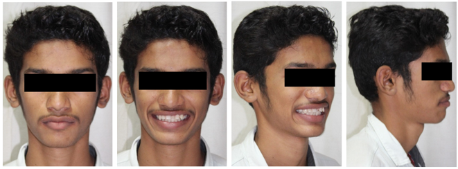 Pre-treatment extraoral photographs.