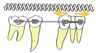 Mechanics of Niti open coil spring
