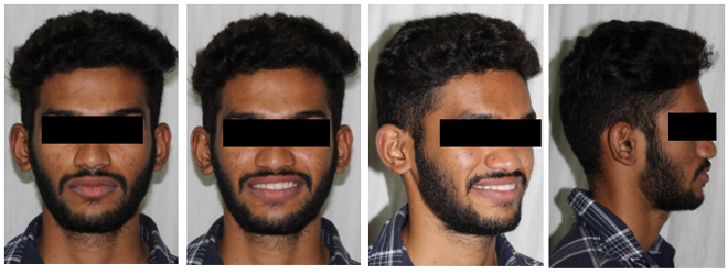 Post-treatment extraoral photographs