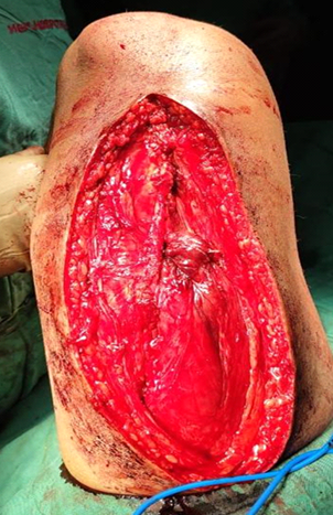 Intraop picture showing repair of rectusfemoris sutured with semitendinosus graft using Biofiber