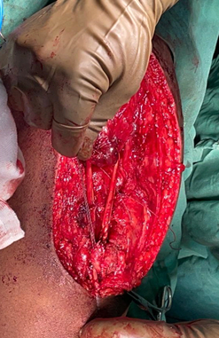 Rip-stop technique with fiber wire to prevent proximal migration of graft into muscle