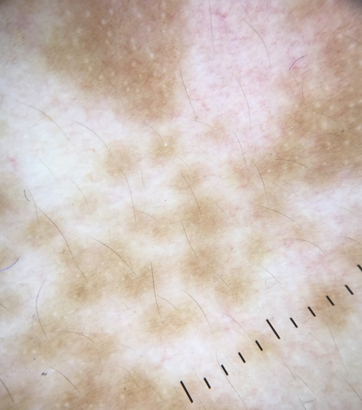 Perifollicular pigmentation- pigmentation around the hair follicle