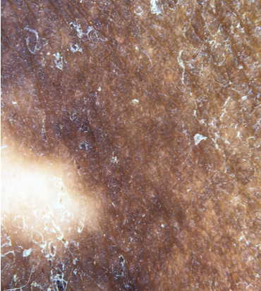 Perilesional/marginal hyperpigmentation- hyperpigmentation around the lesion