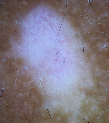 Intra/perilesional erythema with telangiectasia