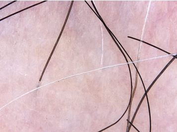 Perifollicular depigmentation