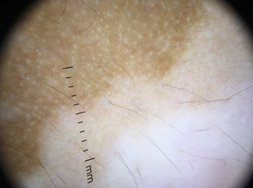 Trichrome Pattern- hypopigmentation in between normal skin and depigmented skin