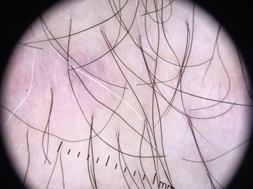 Leukotrichia- presence of white hairs