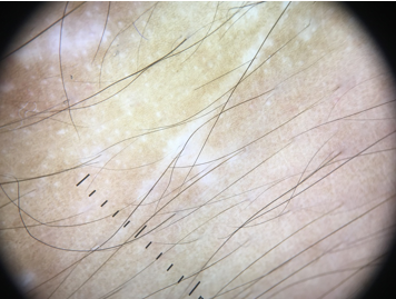 Micro koebner’s phenomenon