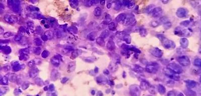 Hepatocellular carcinoma on FNAC smear (MGG stain) (400×)