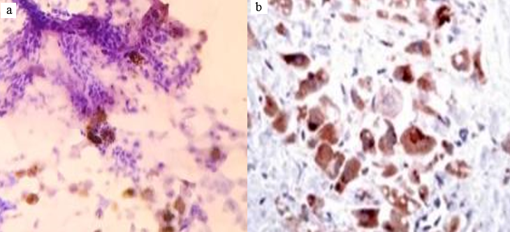 a,b: (Left-Right): Cytoplasmic positivity with glypican -3 (score 2 and score 3, 400×).