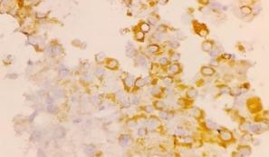 Cytoplasmic positivity with HepPar-1 score 2+ (400×)