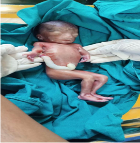 Shows phocomalia abortus with umbilical cord