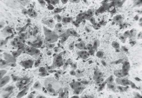Mild Dysplasia (Pap stain)