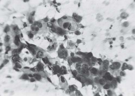 Moderate Dysplasia (Pap stain)
