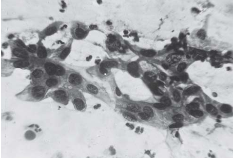 Severe Dysplasia (Pap stain)