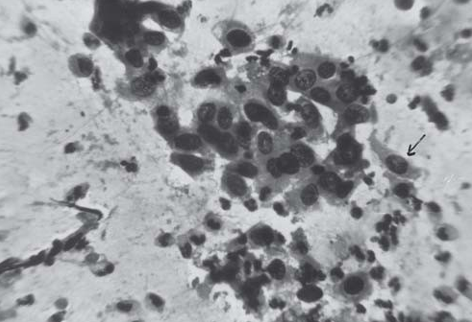 Oral Squamous cell carcinoma (Pap stain)