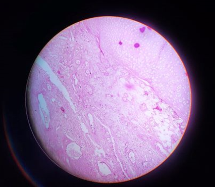 Microphotograph showing features consistent with mature cystic teratoma (100x, H&E)