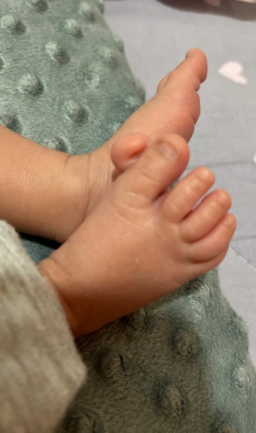 Pre-axial polydactyly of the right foot
