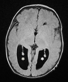 Coronal T1-weighted brain MRI showing enlargement of the occipital lateral ventricles (white stars)