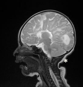 Sagittal T2-weighted brain MRI showing agenesis of the corpus calosum (black arrow) and enlargement of lateral ventricle (white star)