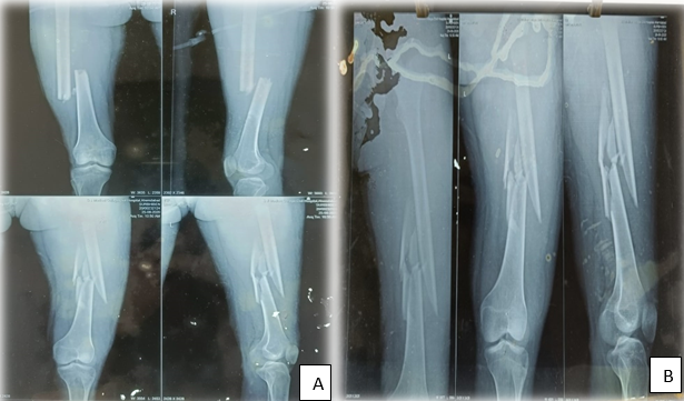 Bilateral shaft femur fracture.