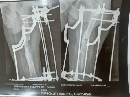 Follow up x ray after 3 months.