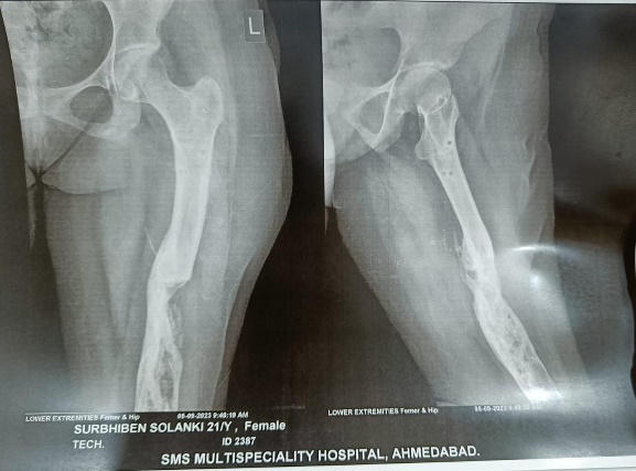 Post-operative X RAY after removal of ilizarov ring.